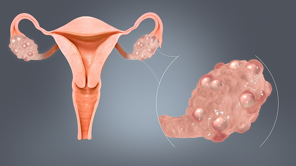 PCOS Treatment in Kolkata